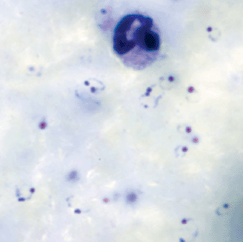 Image: Malaria parasites in a thick blood smear (Photo courtesy of US Centers of Disease Control and prevention).